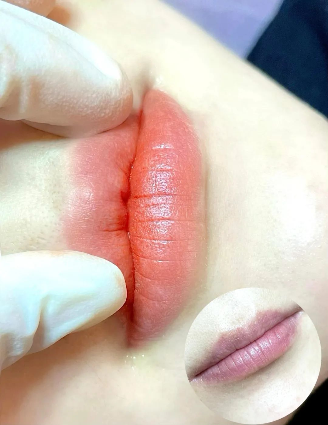 重庆简单的改乌唇方法