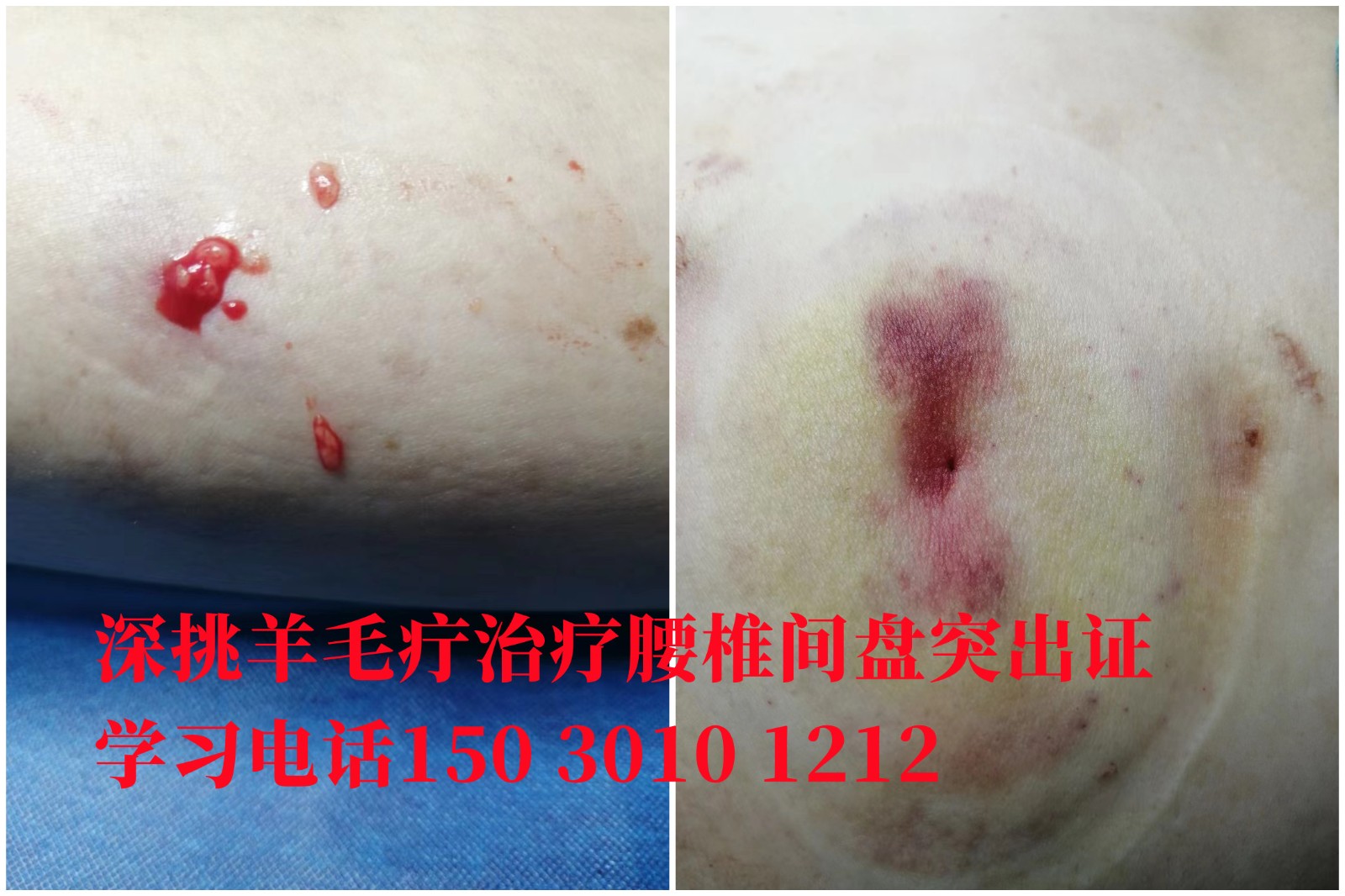 刘丽萍深挑羊毛疔培训 治疗腰椎间盘突出证