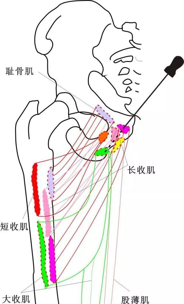 【针刀操作】