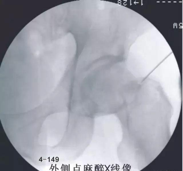 哈尔滨针刀培训股骨头坏死针刀治疗精要​