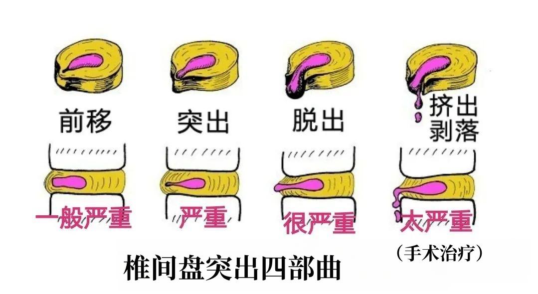 龙氏正骨：腰椎间盘突出症