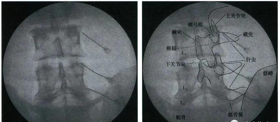 棘突、横突、关节突针刺、针刀定位方法！