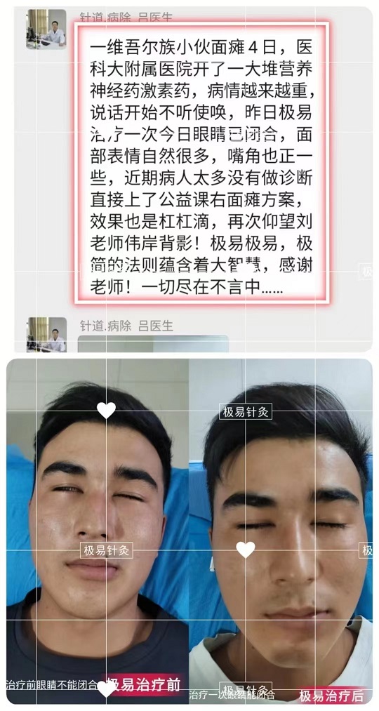 刘朝龙极易针灸治疗面瘫案例分享，