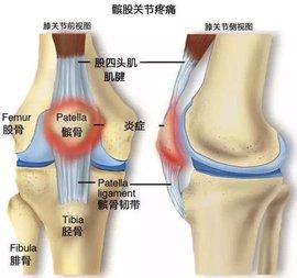 膝关节炎保守治疗方法